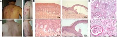 Rituximab Followed by Belimumab Controls Severe Lupus Nephritis and Bullous Pemphigoid in Systemic Lupus Erythematosus Refractory to Several Combination Therapies